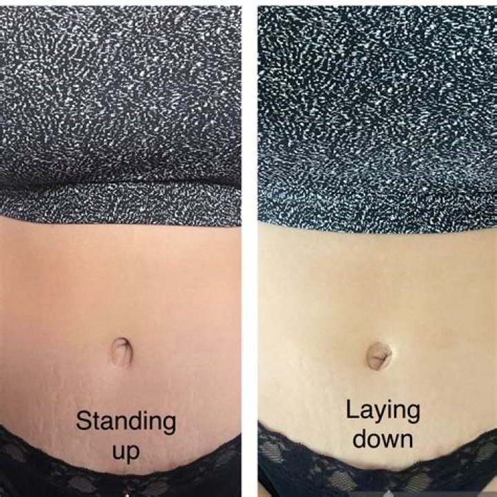 Kim Kardashian’s getting her stretch marks removed & belly button ‘tightened’